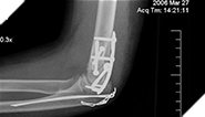 Meet Lindsay - Slip and fall injuries are the most common cause of hospitalization in Canada.